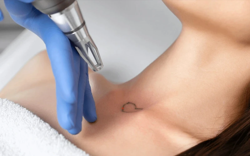 What is general tattoo removal? (Source: Internet)