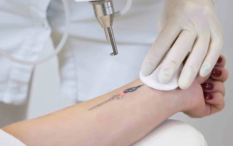 What are the safest and most effective general tattoo removal methods (Source: Internet)