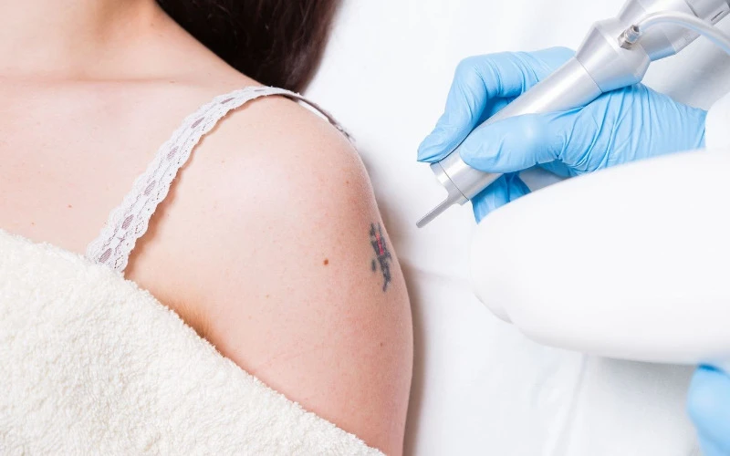 Medical-standard general tattoo removal procedure (source: Internet)