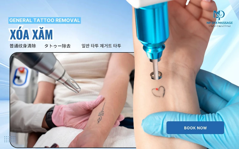 General Tattoo Removal – The solution for quickly fading tattoos at NP SPA (Source: NP SPA MASSAGE)