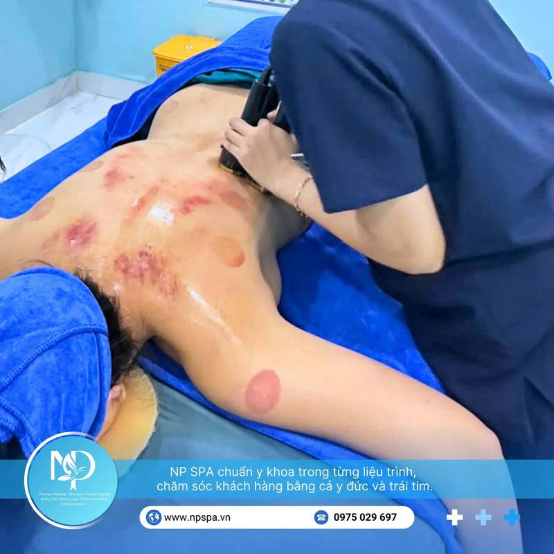 Safe cupping therapy service at NP SPA (Source: NP SPA).