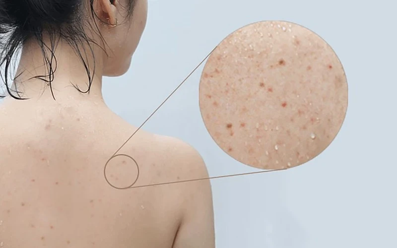 Skin needs back skin care services (Source: Internet)