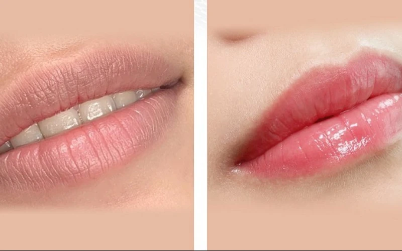 The medical-grade process of collagen lip blush for dark lips correction (Source: Internet)