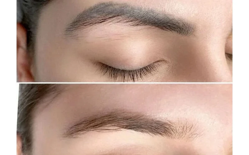 The medical-standard procedure for safe eyebrow tattoo removal (Source: internet)