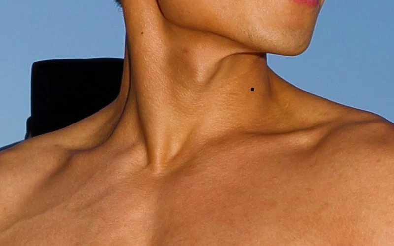 Removing a mole to change one's destiny is a complex issue that needs careful consideration from both feng shui and aesthetic perspectives (Source: internet)