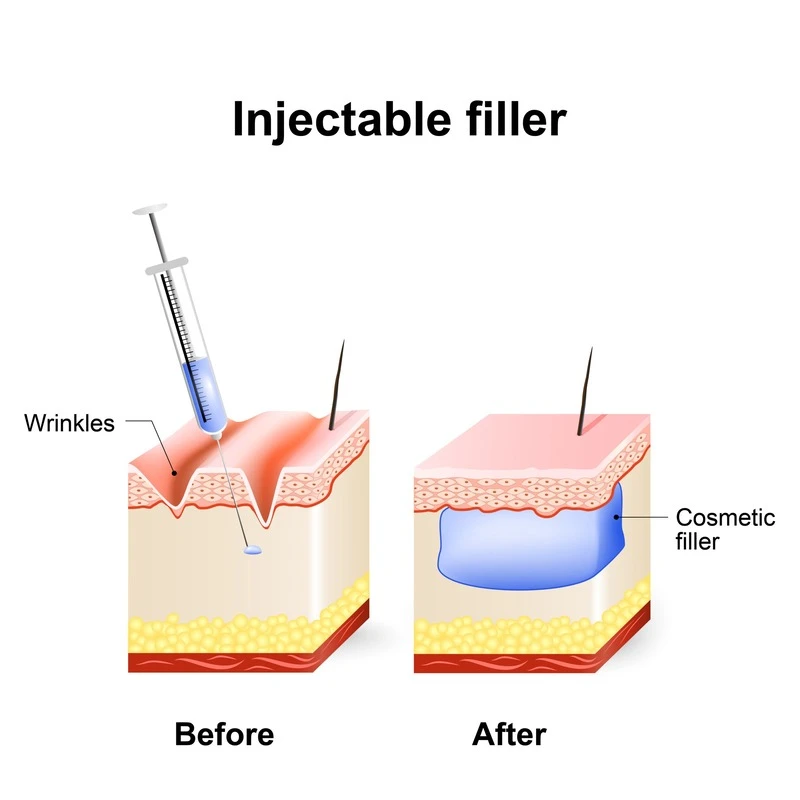 What is Filler (by Volume) injection? (Source: internet)