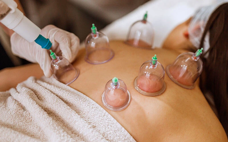 Full body cupping therapy (Source: Internet).