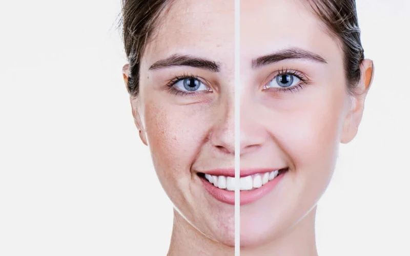 Hydrating & rejuvenating skin tightening treatment Is generally low-risk (Source: Internet)