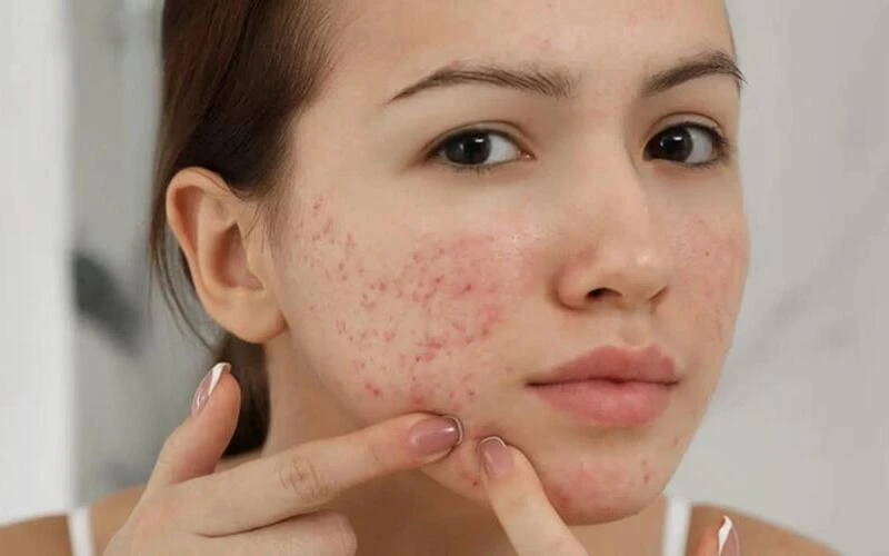 Acne-prone and sagging skin (Source: Internet)