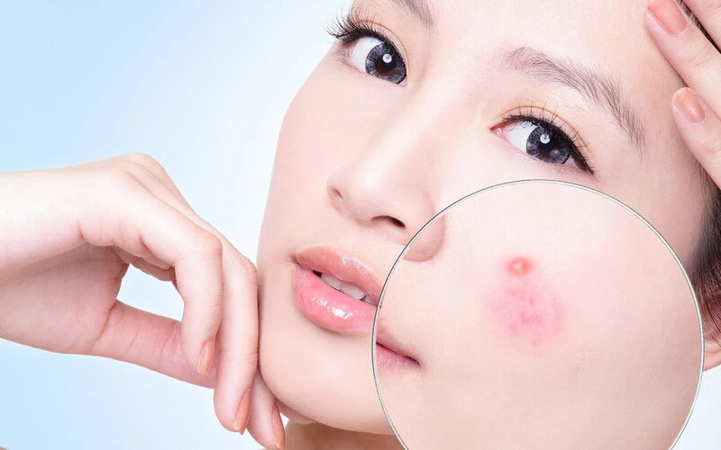 Results after intensive acne treatment (Source: Internet)