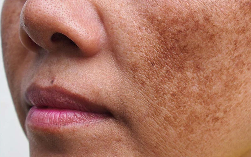 Cases where laser can be used to treat melasma, dark spots, redness, and blackness (Source: Internet)