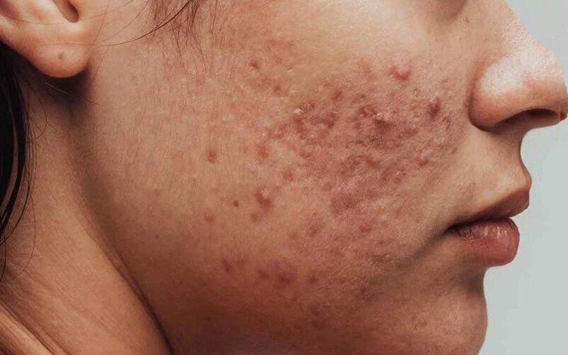 Inflammatory acne can be treated with laser treatment for acnes (Source: Internet)
