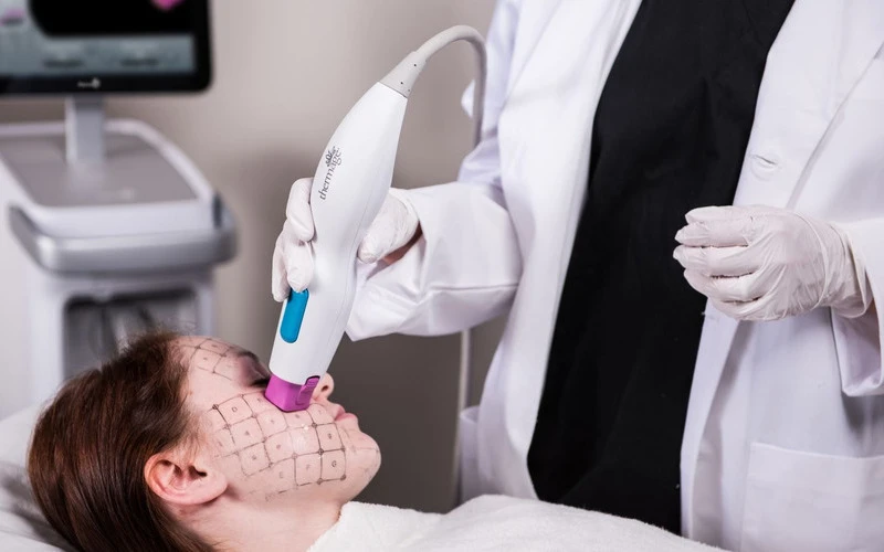 Thermage FLX laser for rejuvenation (Source: Internet)