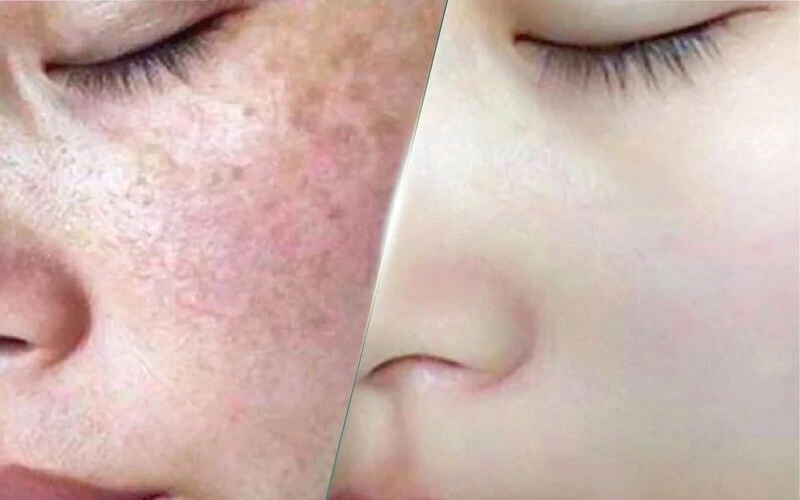 Melasma & redness therapy (Nguồn: Internet)
